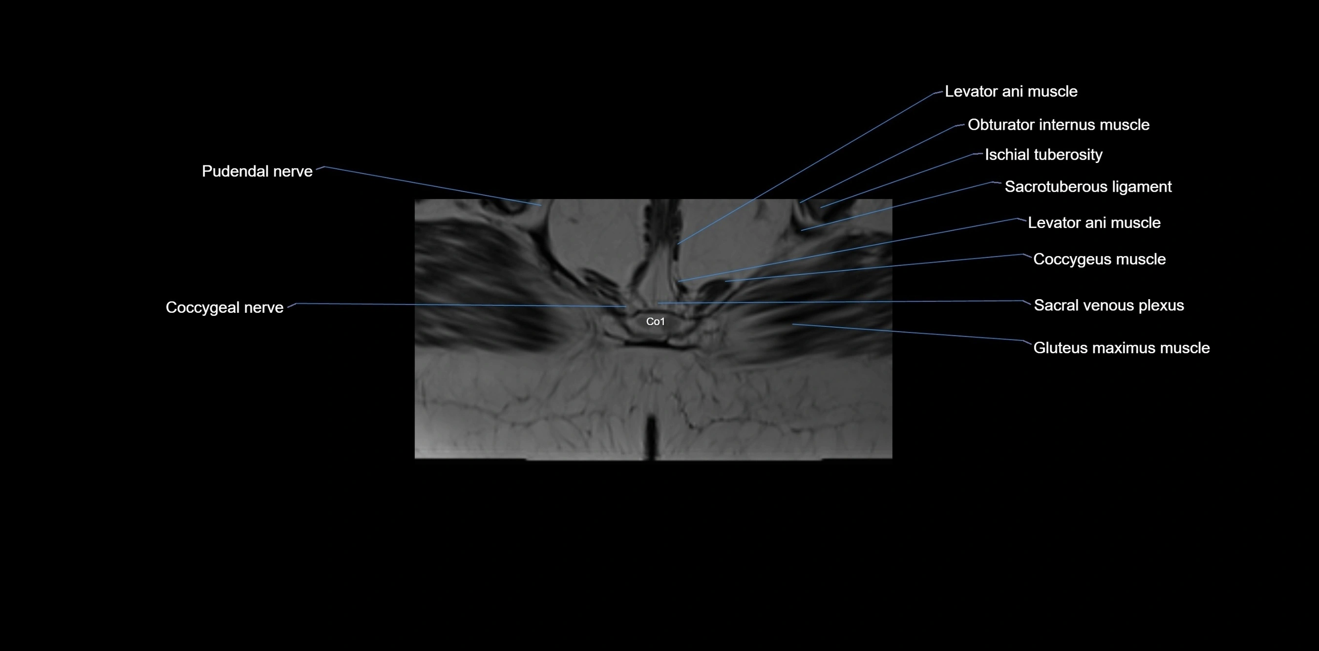 MRI sacrum, coccyx and sacroiliac joint axial cross sectional anatomy 3T  radiology  image-img-00001-00068.webp